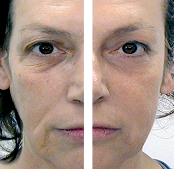 Before & After Treatment Course. Picture Courtesy of CACI International